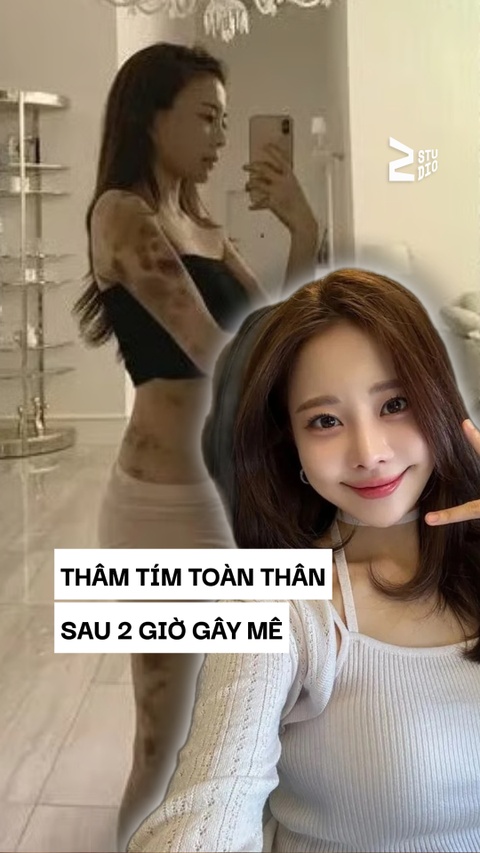 Hot girl Hàn bàng hoàng khi cả cơ thể bầm tím sau 2 giờ gây mê làm đẹp